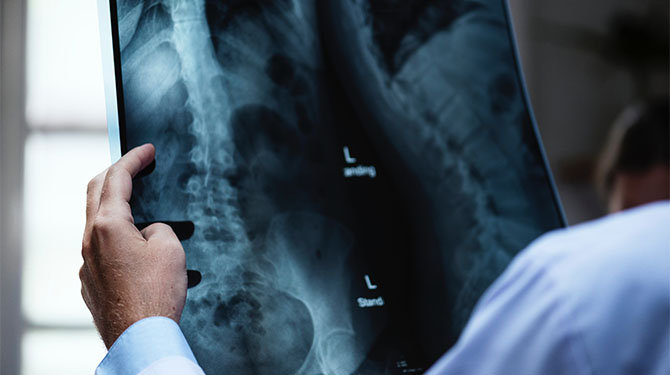 Catholic Health Bone Infection Osteomyelitis