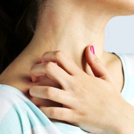 How to Treat Allergic Reactions