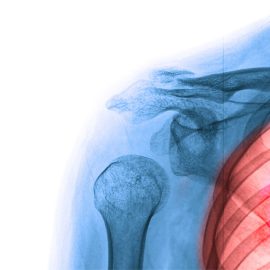 Lung Cancer Resources: Screening, Robotic Surgery, Pathology & Therapy at Catholic Health
